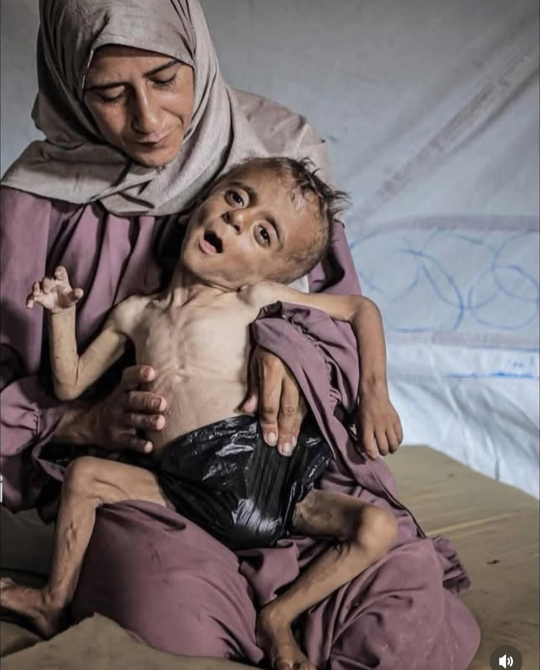 La inanición que sufren como causa del bloqueo humanitario por parte del ESTADO GENOCIDA DE ISRAEL