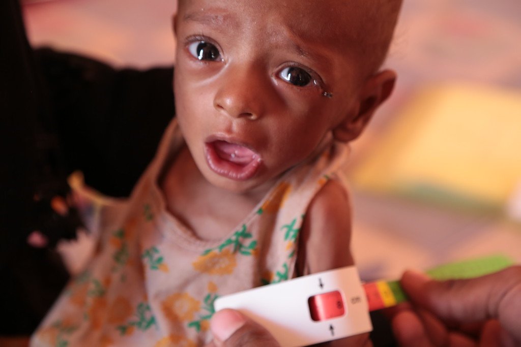 yemen-desnutricion-paz-guerra.jpg yemen-desnutricion-paz-guerra.jpg