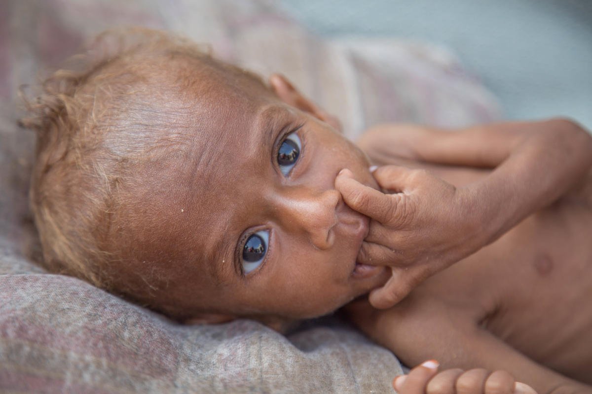 yemen-desnutricion.jpg yemen-desnutricion.jpg