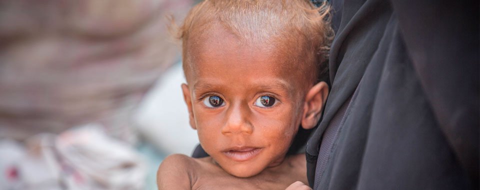 Nusair tenía 13 meses cuando le diagnosticamos con desnutrición severa Nusair tenía 13 meses cuando le diagnosticamos con desnutrición severa