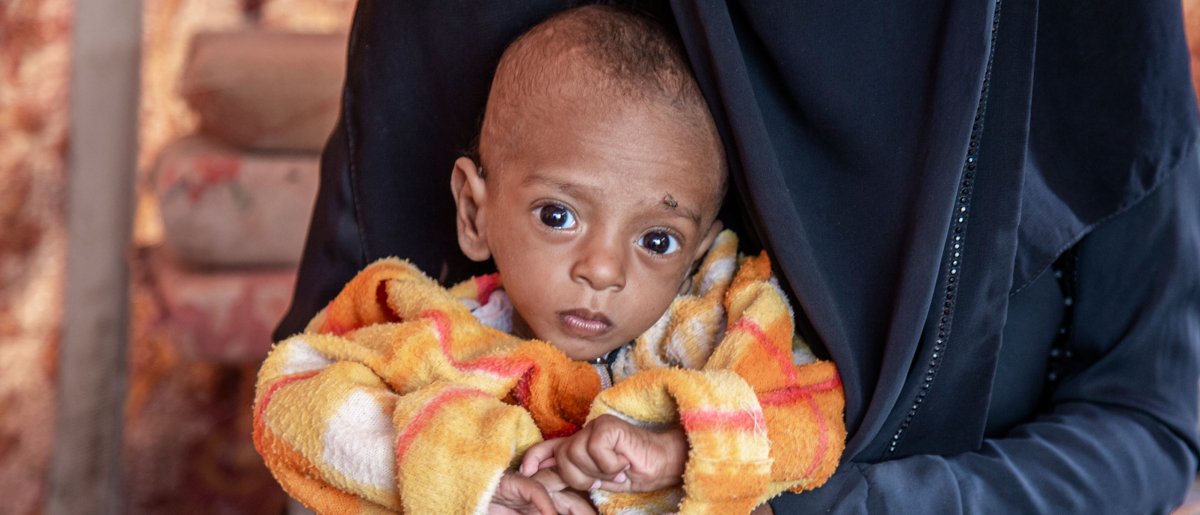 Nabil vino con 8 meses, sufría desnutrición aguda severa Nabil vino con 8 meses, sufría desnutrición aguda severa