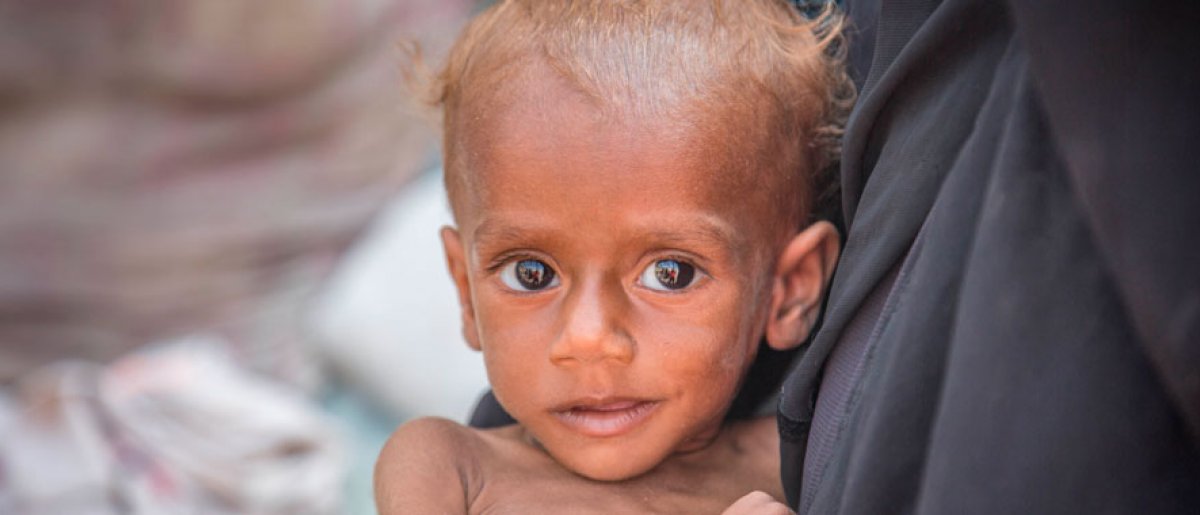 Nusair tenía 13 meses cuando le diagnosticamos con desnutrición severa