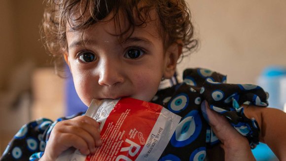 Roya, de 18 meses, sufre desnutrición en Afganistán