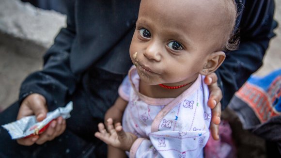 desnutricion-yemen desnutricion-yemen