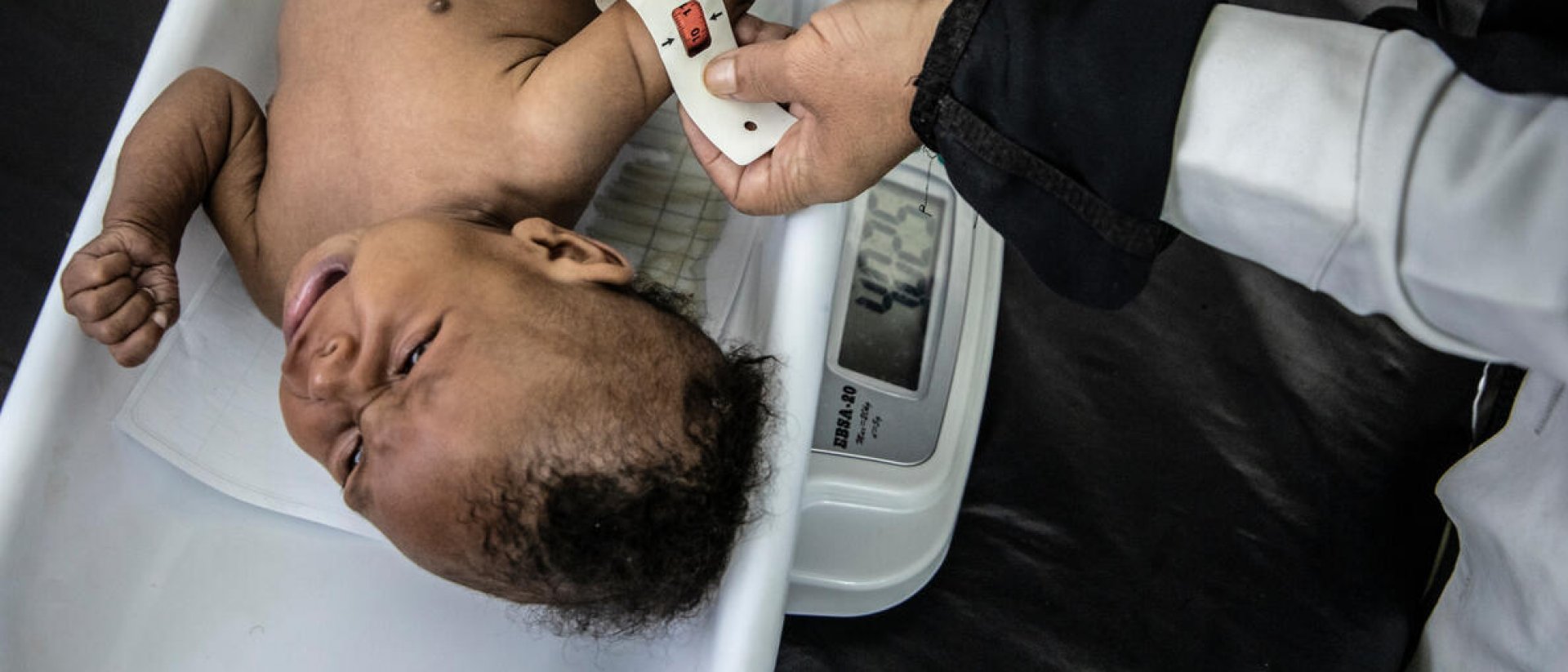 Noor sufría desnutrición MUAC malnutricion