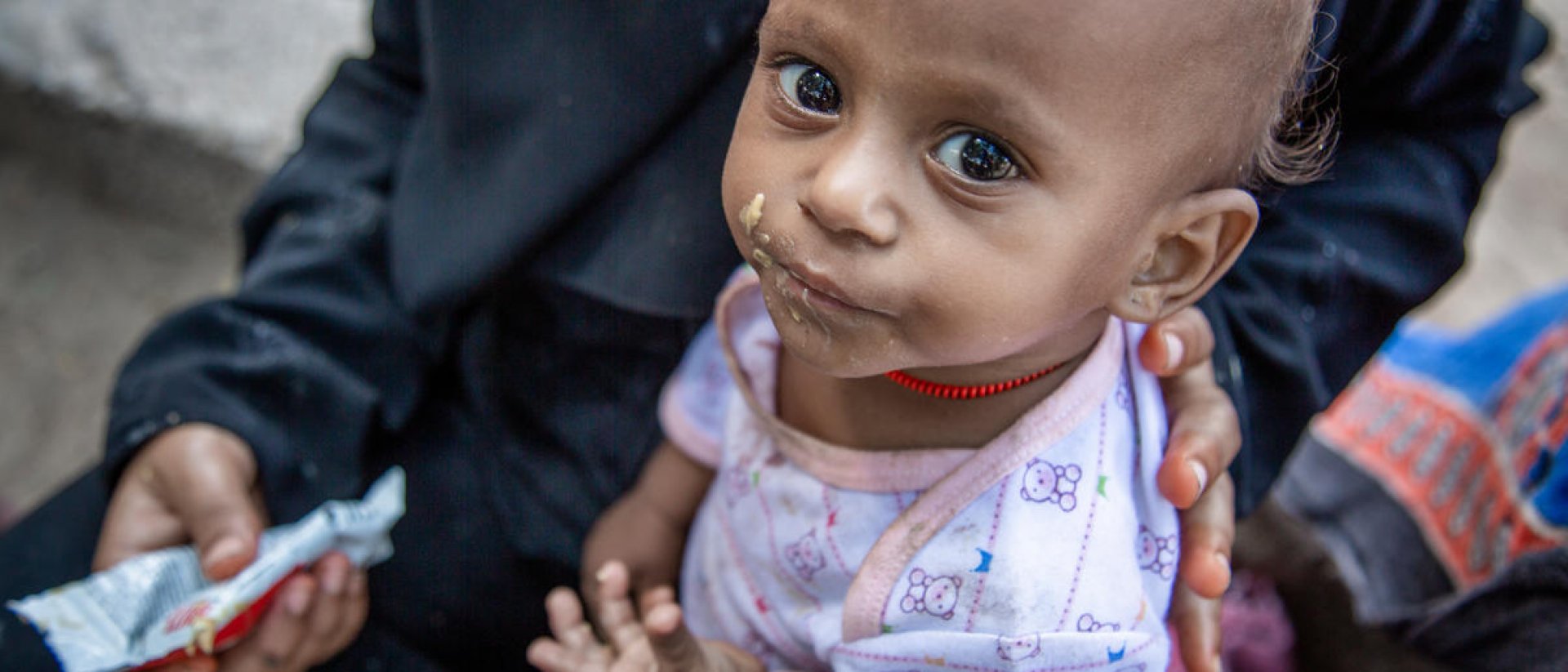 desnutricion-yemen desnutricion-yemen