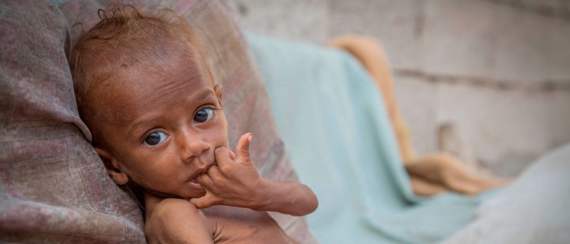 Nusair tenía 13 meses cuando le diagnosticamos con desnutrición severa