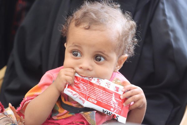 Una niña de 1 año recibe un tratamiento alimentario en una clínica de Save the Children en Sudán