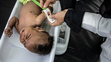 MUAC malnutricion