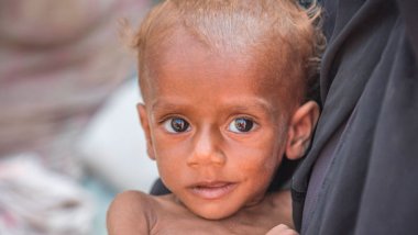 Nusair tenía 13 meses cuando le diagnosticamos con desnutrición severa
