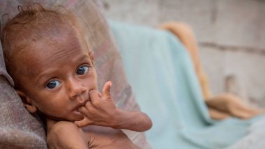 Nusair tenía 13 meses cuando le diagnosticamos con desnutrición severa